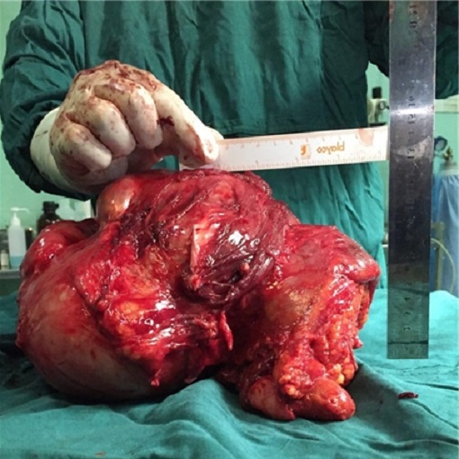 تصویر تومور 8 کیلویی خارج شده از پای یک بیمار ساروی!!